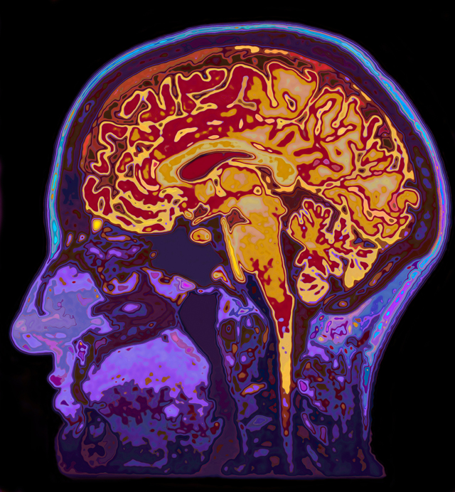 Un implante de grafeno detecta actividad cerebral a frecuencias extremadamente bajas