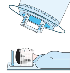 Radioterapia en la antigüedad
