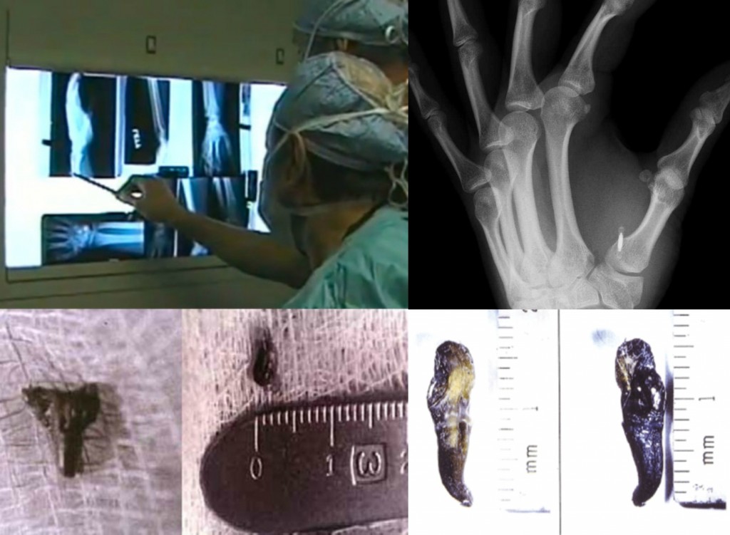 Sobre la evidencia física de los implantes alienígenas en abducidos