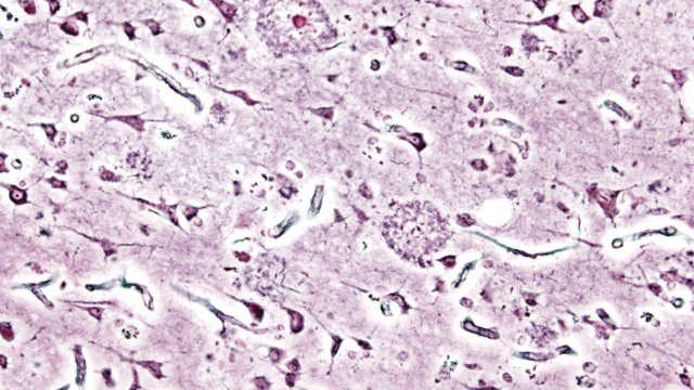 Vacuna contra el Alzheimer ya está lista para ensayos en humanos   