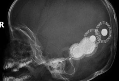 Implantes etéricos: Donde y como operan. Implantes etéricos: Donde y como operan.
