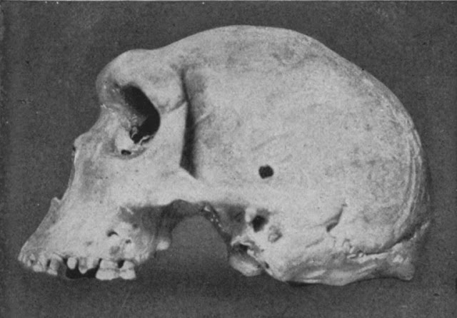 El cráneo encontrado en Kabwe (también conocido como Broken Hill) atrajo una gran atención cuando fue descubierto por primera vez.