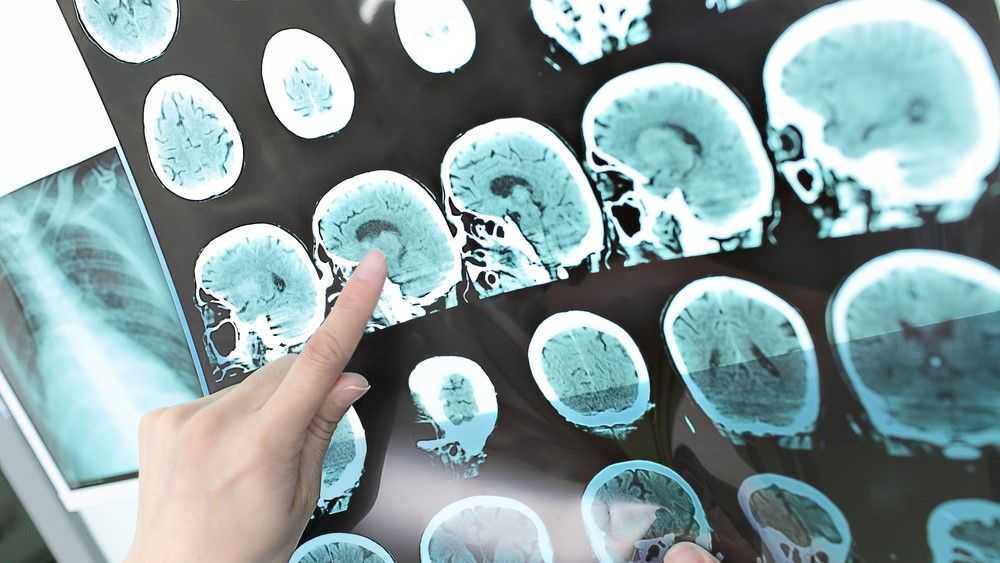 Escaneo de un cerebro humano moribundo